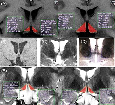 Clinical Implication of Individually Tailored Segmentation Method for Distorted Hypothalamus in Craniopharyngioma